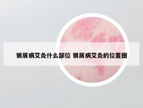 银屑病艾灸什么部位 银屑病艾灸的位置图