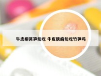 牛皮癣莴笋能吃 牛皮肤癣能吃竹笋吗