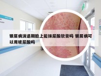 银屑病消退期脸上能抹尿酸软膏吗 银屑病可以用玻尿酸吗