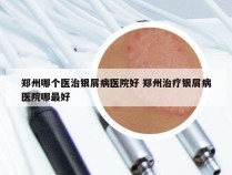 郑州哪个医治银屑病医院好 郑州治疗银屑病医院哪最好
