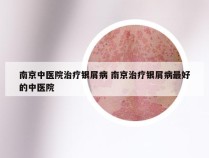 南京中医院治疗银屑病 南京治疗银屑病最好的中医院