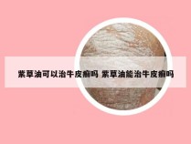 紫草油可以治牛皮癣吗 紫草油能治牛皮癣吗