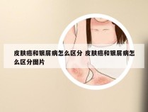 皮肤癌和银屑病怎么区分 皮肤癌和银屑病怎么区分图片