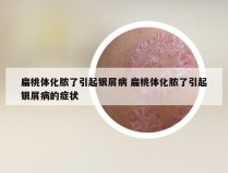 扁桃体化脓了引起银屑病 扁桃体化脓了引起银屑病的症状