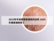 2023年牛皮癣银屑病有的冶吗 2020年银屑病有救了