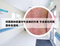 阿莫西林胶囊对牛皮癣的作用 牛皮癣吃阿莫西林有用吗