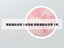 银屑病吃白萝卜会发病 银屑病能吃生萝卜吗