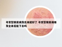 寻常型银屑病发出来就好了 寻常型银屑病爆发全身后能下去吗