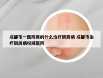 成都市一医院用的什么治疗银屑病 成都市治疗银屑病权威医院