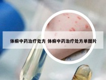 体癣中药治疗处方 体癣中药治疗处方单图片