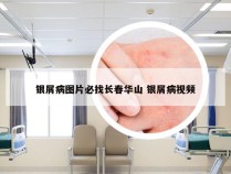 银屑病图片必找长春华山 银屑病视频