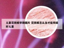 儿童花斑癣早期图片 花斑癣怎么治才能彻底好儿童