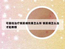 可善挺治疗银屑病效果怎么样 银屑病怎么治才能断根