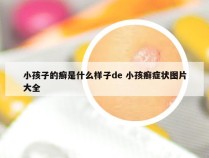 小孩子的癣是什么样子de 小孩癣症状图片大全