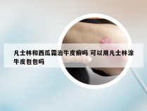 凡士林和西瓜霜治牛皮癣吗 可以用凡士林涂牛皮包包吗