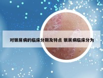 对银屑病的临床分期及特点 银屑病临床分为