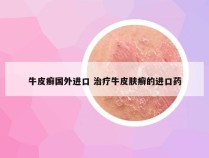 牛皮癣国外进口 治疗牛皮肤癣的进口药