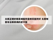 太原正规的银屑病医院是哪家医院好 太原哪里有治银屑病的老中医