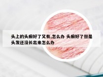 头上的头癣好了又有,怎么办 头癣好了但是头发还没长出来怎么办