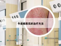 牛皮癣真实的治疗方法
