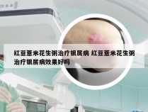 红豆薏米花生粥治疗银屑病 红豆薏米花生粥治疗银屑病效果好吗