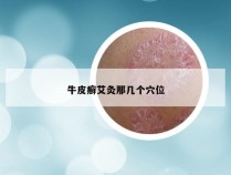 牛皮癣艾灸那几个穴位