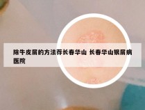 除牛皮屑的方法荐长春华山 长春华山银屑病医院