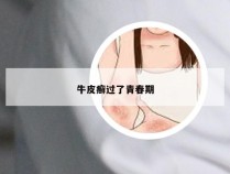 牛皮癣过了青春期