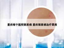 重庆哪个医院银屑病 重庆银屑病治疗费用