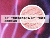 长了一个癣越来越大是什么 长了一个癣越来越大是什么病