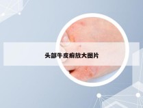 头部牛皮癣放大图片