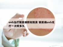 uvb治疗银屑病照射距离 银屑病uvb光疗一次照多久
