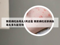 银屑病吃血毒丸3天还是 银屑病吃皮肤病血毒丸多久能见效
