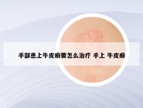 手部患上牛皮癣要怎么治疗 手上 牛皮癣