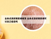 全身点滴状银屑病爆发 全身点滴状银屑病可以自己痊愈吗