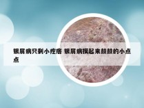 银屑病只剩小疙瘩 银屑病摸起来鼓鼓的小点点