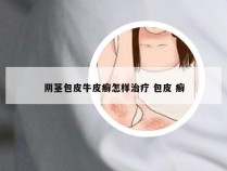 阴茎包皮牛皮癣怎样治疗 包皮 癣