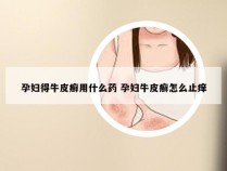 孕妇得牛皮癣用什么药 孕妇牛皮癣怎么止痒