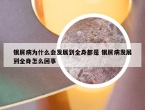 银屑病为什么会发展到全身都是 银屑病发展到全身怎么回事