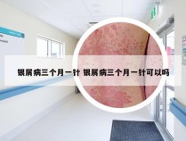 银屑病三个月一针 银屑病三个月一针可以吗