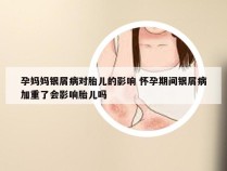 孕妈妈银屑病对胎儿的影响 怀孕期间银屑病加重了会影响胎儿吗
