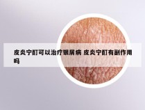 皮炎宁酊可以治疗银屑病 皮炎宁酊有副作用吗