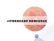 24岁银屑病自愈案例 银屑病的自我治愈