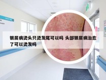 银屑病烫头只烫发尾可以吗 头部银屑病治愈了可以烫发吗
