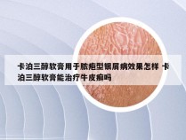 卡泊三醇软膏用于脓疱型银屑病效果怎样 卡泊三醇软膏能治疗牛皮癣吗