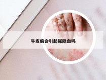 牛皮癣会引起尿隐血吗