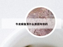 牛皮癣复发什么原因导致的