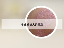 牛皮癣病人的禁忌