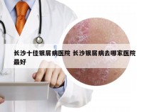 长沙十佳银屑病医院 长沙银屑病去哪家医院最好