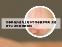 擦牛皮癣药达力士对怀孕孩子有影响吗 用达力士可以修复银屑病吗